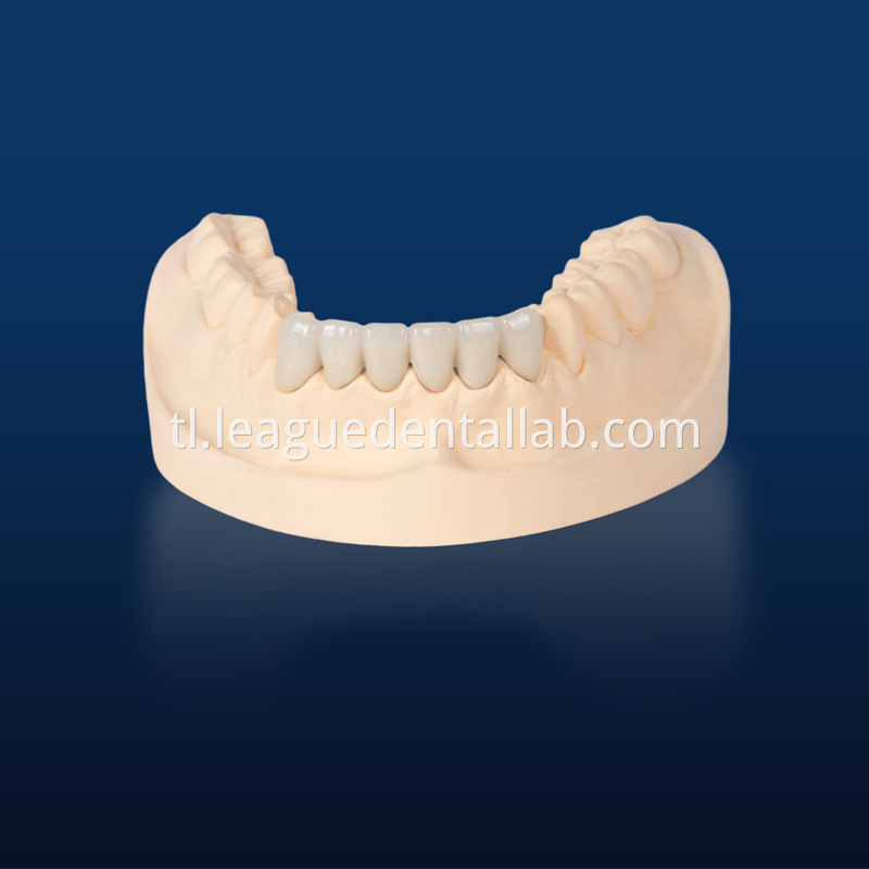 PFM,Metal crown,Fixed metal crown